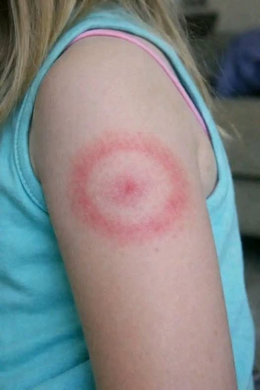 My daughter woke up with this strange red ring on her arm. It’s not itchy but looks spreading. I’m panicking, do I need to rush her in?