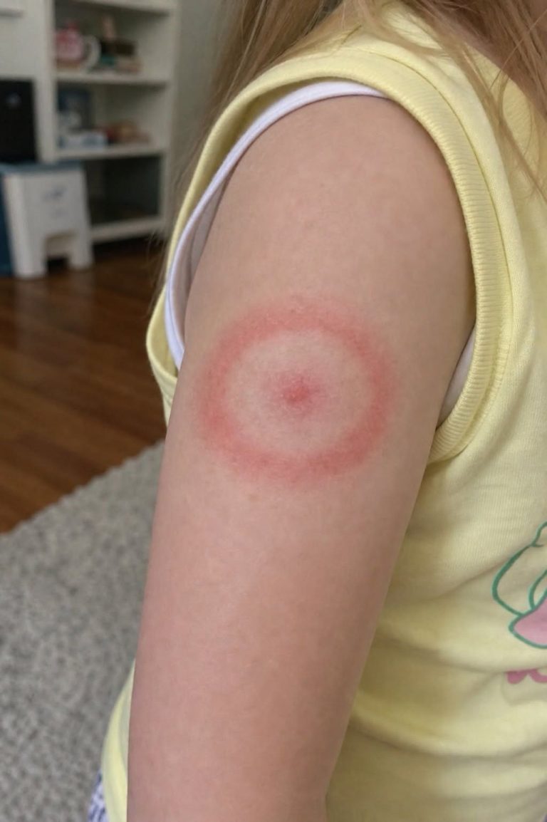 The Red Ring of Terror: Is Your Child’s Mysterious Rash a Harmless Bug Bite or a Life-Changing Diagnosis?